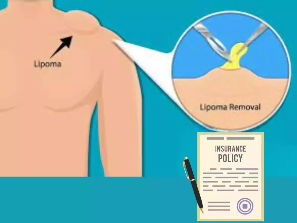 Lipoma Removal Covered by Insurance
